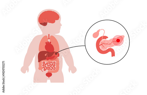 Pancreas diseases in a child