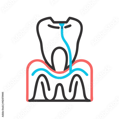 Dental Abscess Illustration Showing Infection of Tooth Root