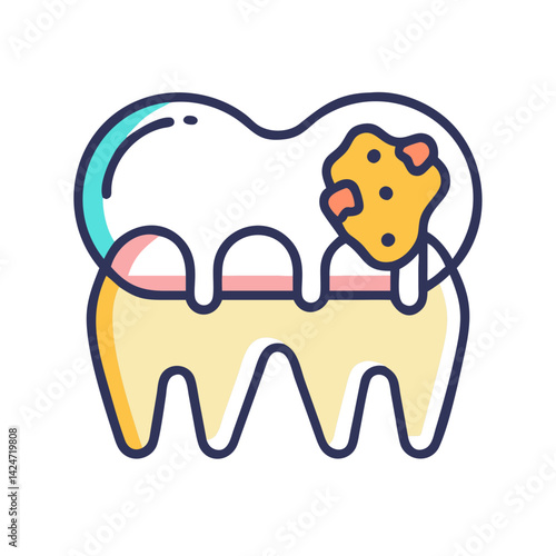Tooth Decay Illustration of Dental Caries on Molars
