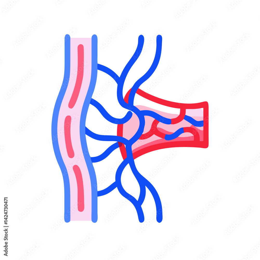 Fototapeta premium Arteriovenous Malformation (AVM) Diagram in Brain, Color Illustration