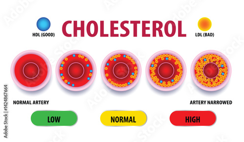 Cholesterol in artery, health risk , vector design