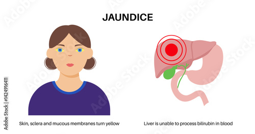 Jaundice yellow skin