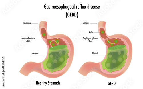 Gastroesophageal reflux disease GERD stomach contents move up into the esophagus, reflux becomes a disease severe symptoms or injury