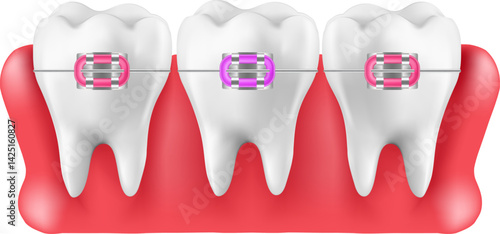 Installing braces on teeth, straightening crooked bites. Vector illustration