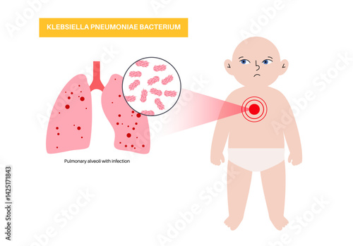 Klebsiella pneumoniae poster