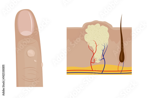 Common warts growing on finger and cross section of wart anatomy