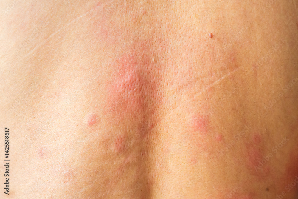 Young asian man itching and scratching on his back from allergic itchy dry skin eczema dermatitis insect bites Young asian man itching and scratching on his back from allergic itchy dry skin eczema dermatitis insect bites