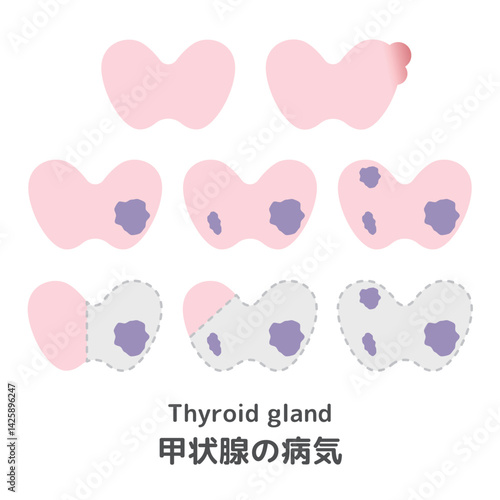 甲状腺