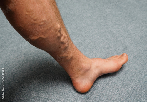 Varicose veins. Phlebology and DVT. Varicose veins on leg of man. Varicosity on legs, spider veins, edema, health illness concept. Phlebeurysm and thrombophlebitis of veins. Phlebology concept.