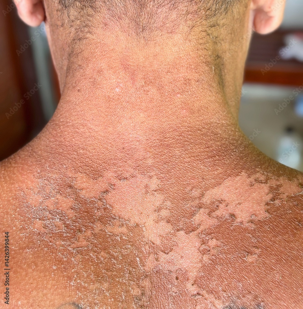 Fototapeta premium Peeling Skin After a Sunburn, exposed to the sun for a long time