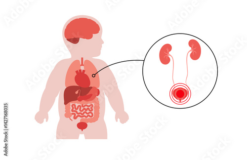 Kidney diseases in a child