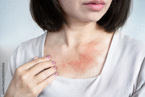 close-up of a woman with a rash and red, irritated skin on her neck, feeling itchy due to sensitive skin conditions like dryness, eczema, allergic reactions, or sweat from hot weather