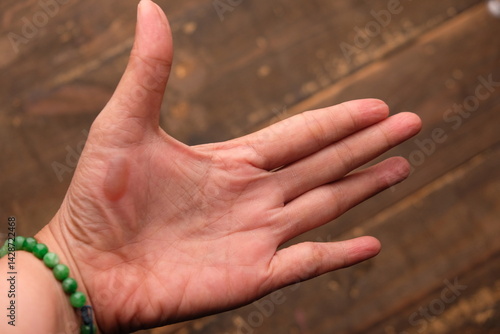 burns on the palms. blistered palms.