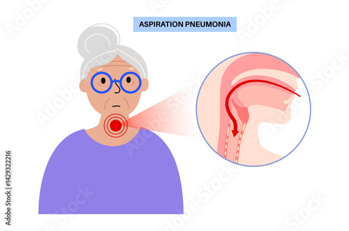 Aspiration pneumonia poster