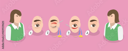 3D Isometric Flat Vector Illustration of Eyelid Surgery Procedure, Removing Excess Skin Treatment