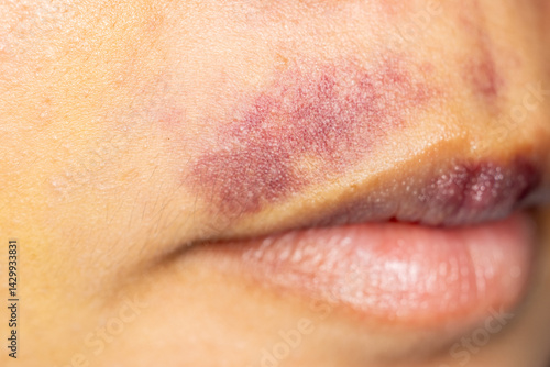 Background image of wounds caused by Systemic Lupus erythematosus (SLE) or Lupus.
