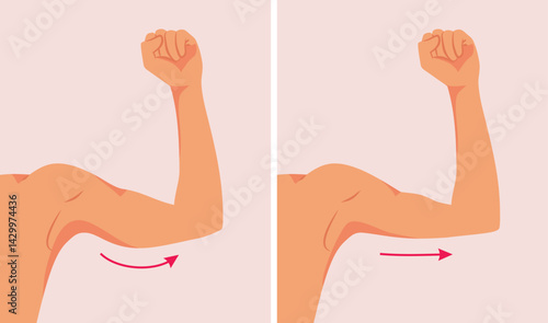 Arm Undergoing Brachioplasty Procedure Vector Illustration. Surgical procedure that reshapes the back part and the under surface of the upper arm 

Brachioplasty Procedure Vector Illustration.eps