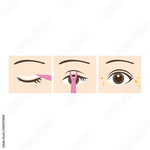 一重まぶたを二重まぶたにするイラスト
