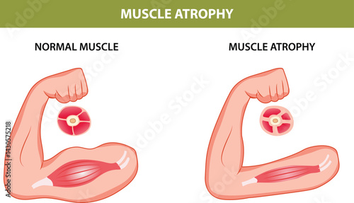 Muscle Pain Nerve Waste Injury Arm Stock Vector Illustration (Royalty Free)