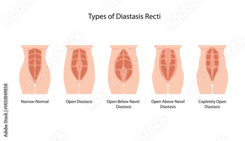 Different types of Diastasis Recti. Woman anatomy. Vector illustration of diastasis after pregnancy. 