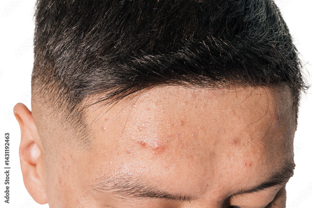 Obraz premium Cystic and hormonal acne on a man's face