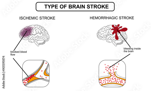 Brain stroke, hemorrhagic and ischemic. Arteriosclerosis, infarct, ischemia, thrombosis disease. Cholesterol in human blood vessels. Medical poster vector illustration.