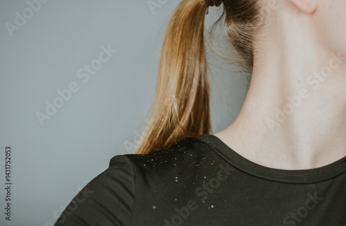 Dandruff from psoriasis from scalp on shoulder of woman close up