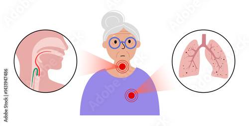 Aspiration pneumonia poster