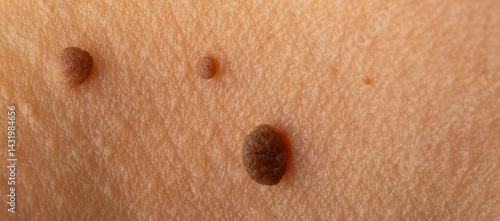 Multiple seborrheic keratoses growing on human skin