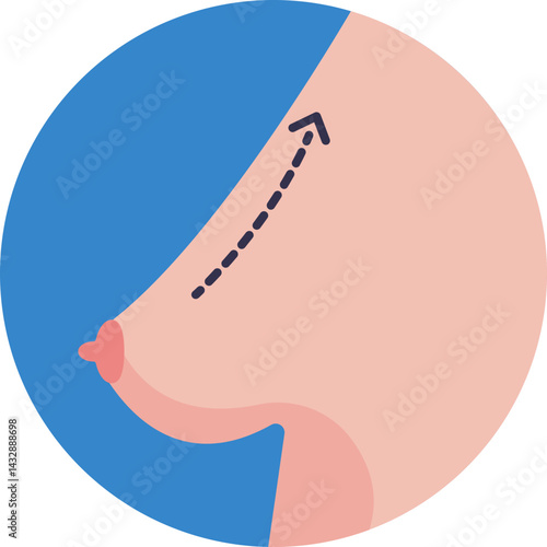 A representation of a breast implant, commonly used to enhance breast size or restore volume after surgery.