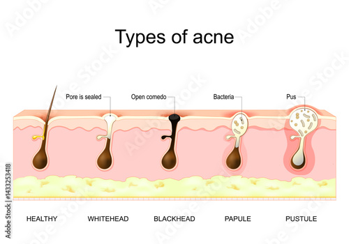 Types of acne pimples. Cross section of a human skin