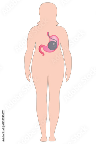 Woman body silhouette showing stomach with gastric balloon inside for weight loss.