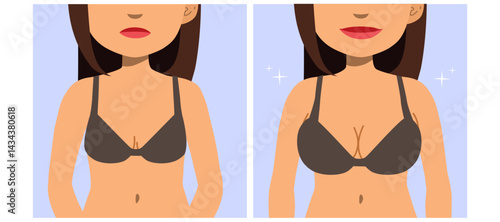 Cartoon illustration of a woman’s body in before and after breast augmentation surgery. Plastic surgery concept focused on body enhancement, bust reshaping, and cosmetic transformation