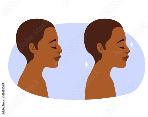 Cartoon illustration showing a side profile view of a woman before and after rhinoplasty. Cosmetic plastic surgery concept nose correction
