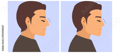 Cartoon illustration of a male patient profile showing before and after rhinoplasty surgery. Cosmetic plastic surgery concept for nose reshaping, aesthetic improvement, and facial enhancement. Drawing