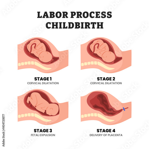 Stages of labor or childbirth process stages, educational medical poster design healthcare scheme, labeled cervical dilatation, fetal expulsion, delivery of placenta. Fetal movement during the labor.