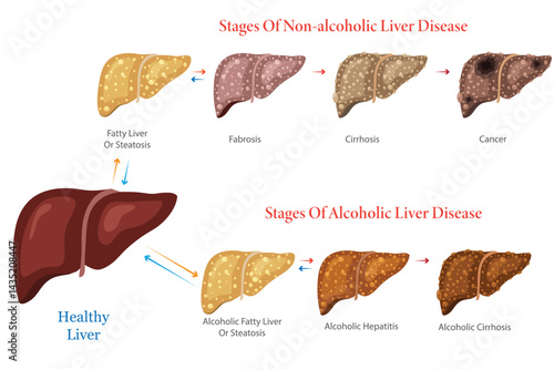 Diagram of Non Alcoholic and Alcoholic Liver Disease Stages Illustration