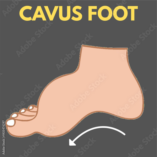 cavus foot or pes cavus deformity of foot high arch foot illustration useful for orthopedics diseases content