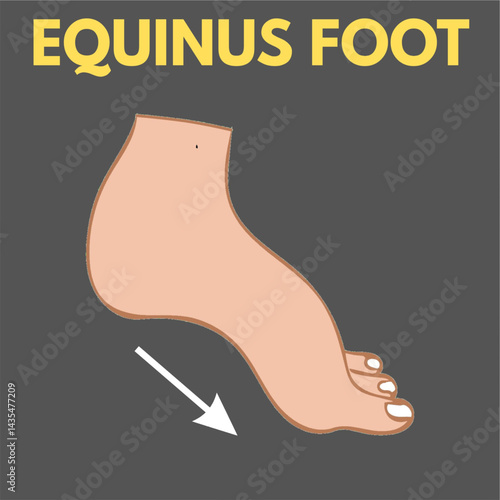 equinus foot deformity orthopedics disease illness illustration healthcare