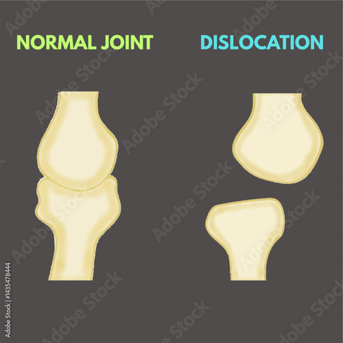NORMAL JOINT VERSUS DISLOCATION illustration comparison diagram useful for healthcare industry