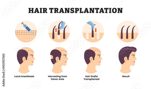 Stages of hair transplantation surgical procedure stages, educational medical poster design healthcare scheme, labeled removes hair follicles from one part of the body, local anesthesia, hair grafts.
