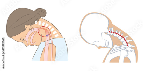 首下がり症で咽頭が狭くなった女性とその骨格イラスト