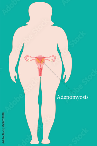 Obese woman silhouette showing adenomyosis in uterus with medical illustration detail on green background.