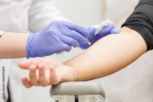 Tableau sur toile Medical professional performing an allergy skin test by pricking the patient for