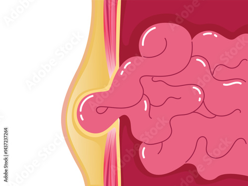 Internal organs abnormal condition, Choked Hernia, Umbilical hernia, Medical poster