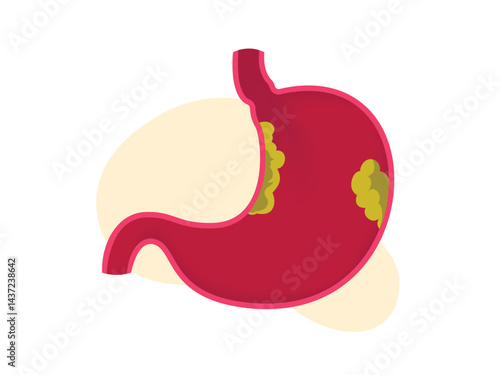 Stomach cancer. Malignant cancerous tumor, Internal organs abnormal condition