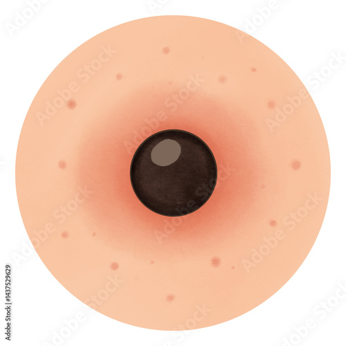 Types of Acne illustration 