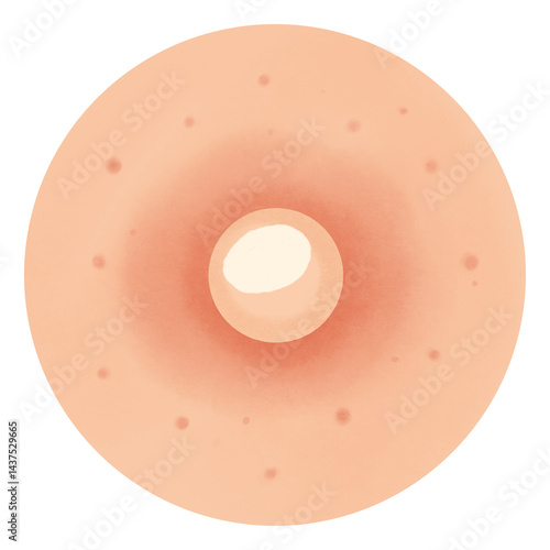 Types of Acne illustration 