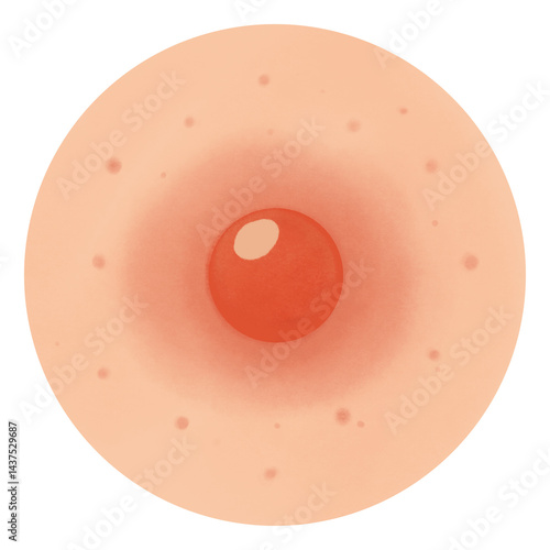 Types of Acne illustration 