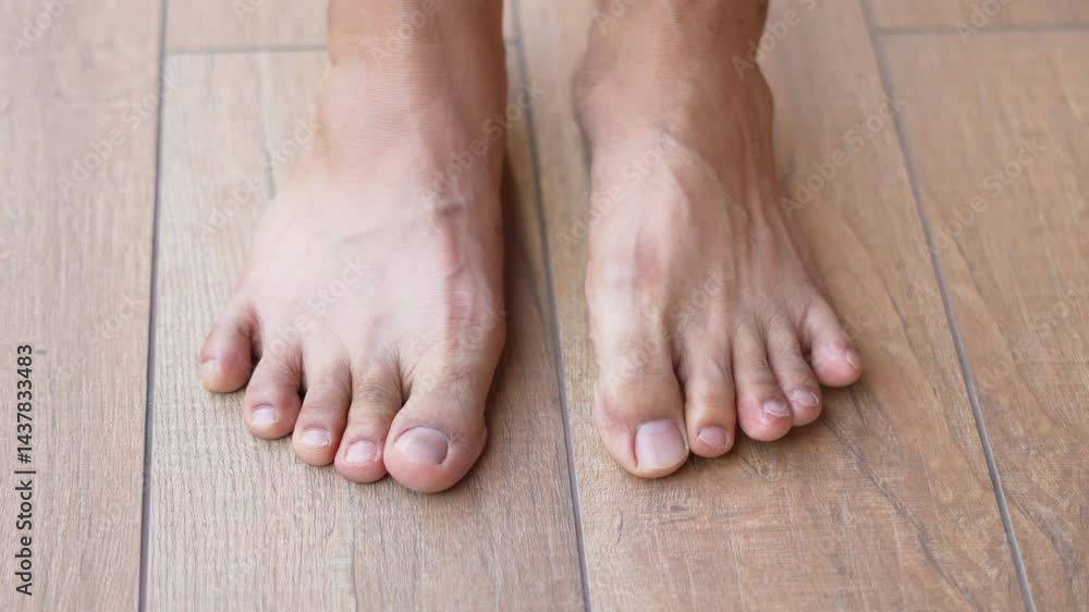 Man get athlete's foot which is caused by a fungal infection on the skin on their feet. Man get athlete's foot which is caused by a fungal infection on the skin on their feet.
